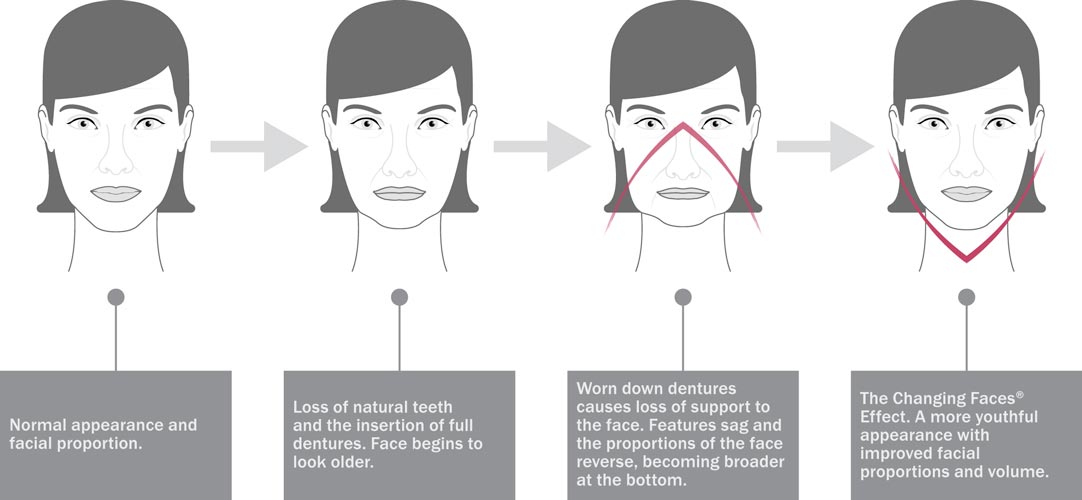 Facelift_illustration-500